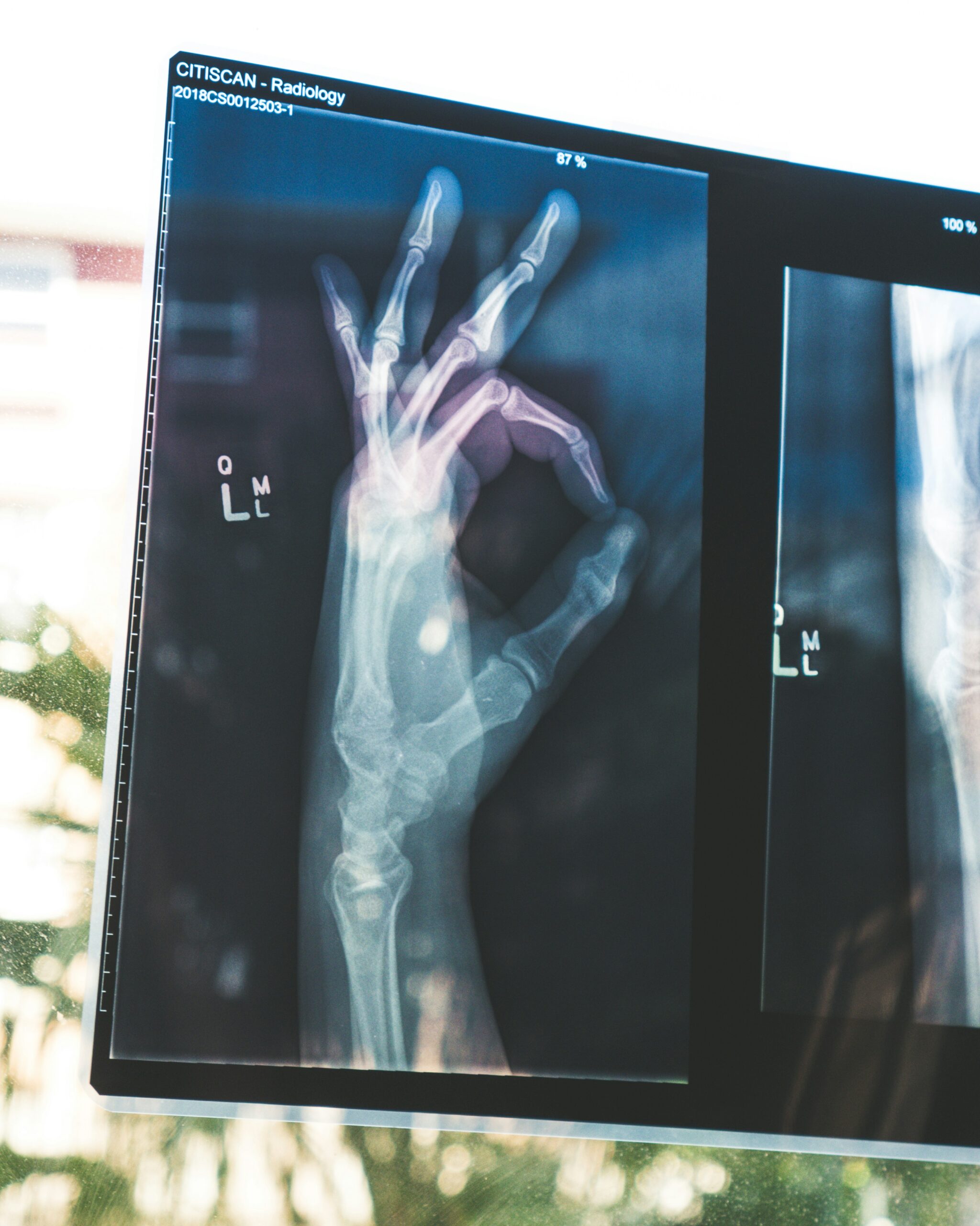 radiographie / scanner du squelette de la main
